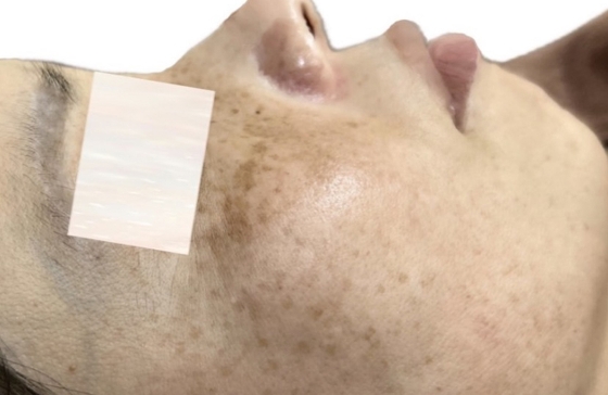 シミ美白改善コース